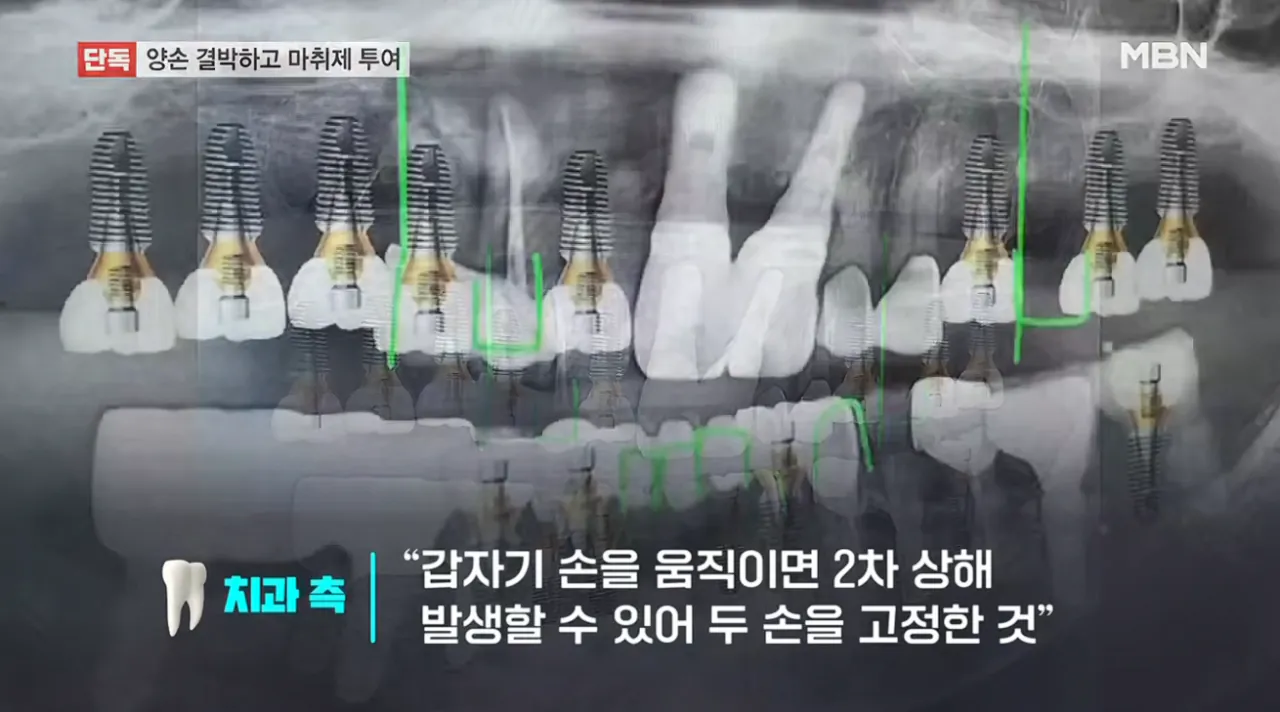 임플란트 사망 CCTV 봤더니 수술대에 양손 결박 후 마취제 투여 (14)