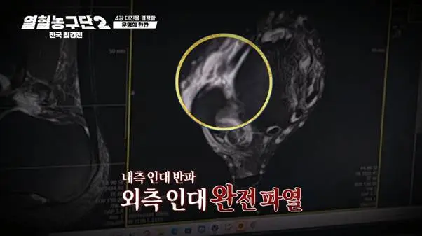 외측인대 완전파열 부상 겪고 6주만에 코트 복귀했다는 남자.jpg (9)