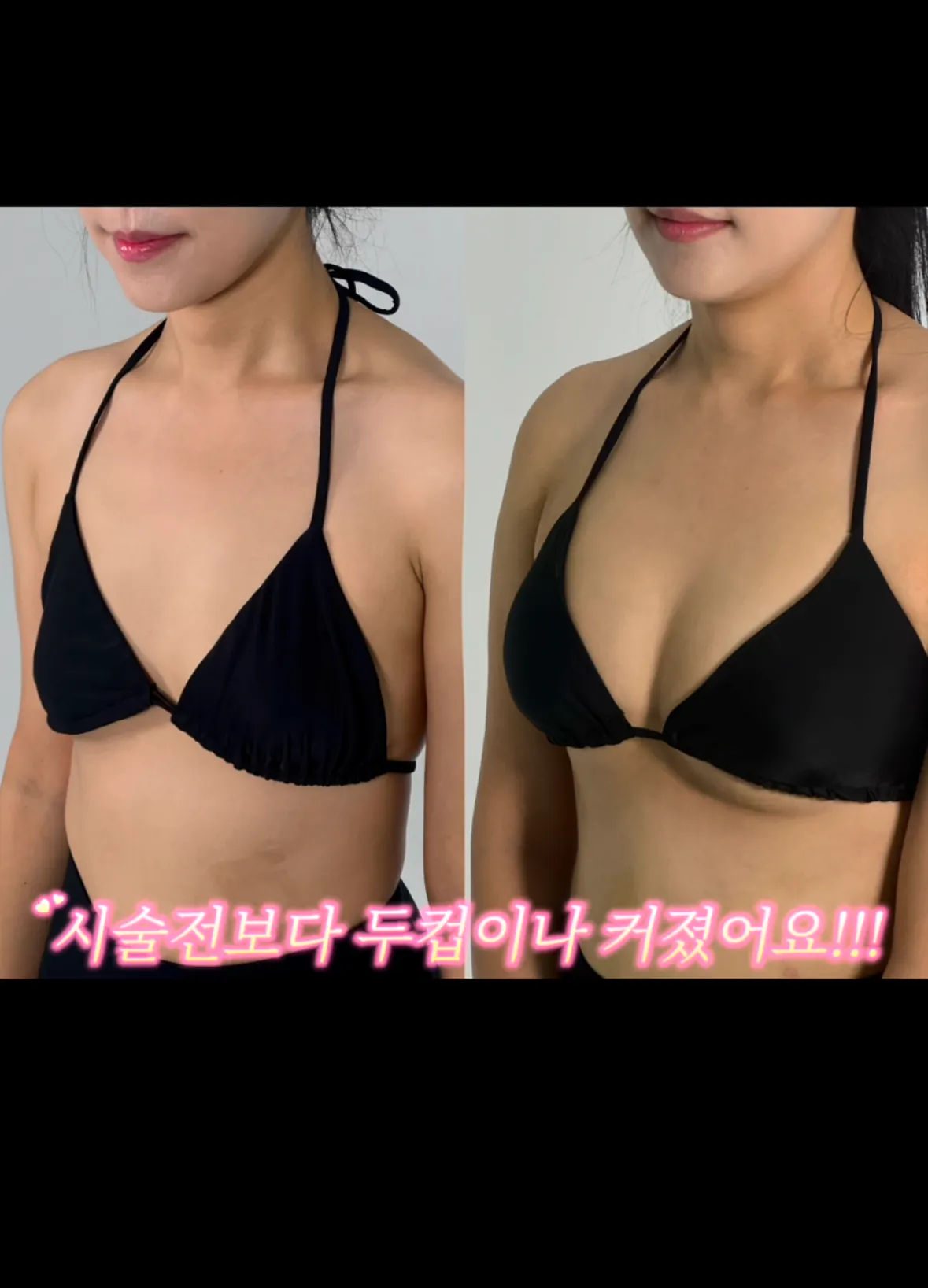 요즘 여자들 사이에 유행중인 신종 몸매 성형수술 허파고리 수술 (11)
