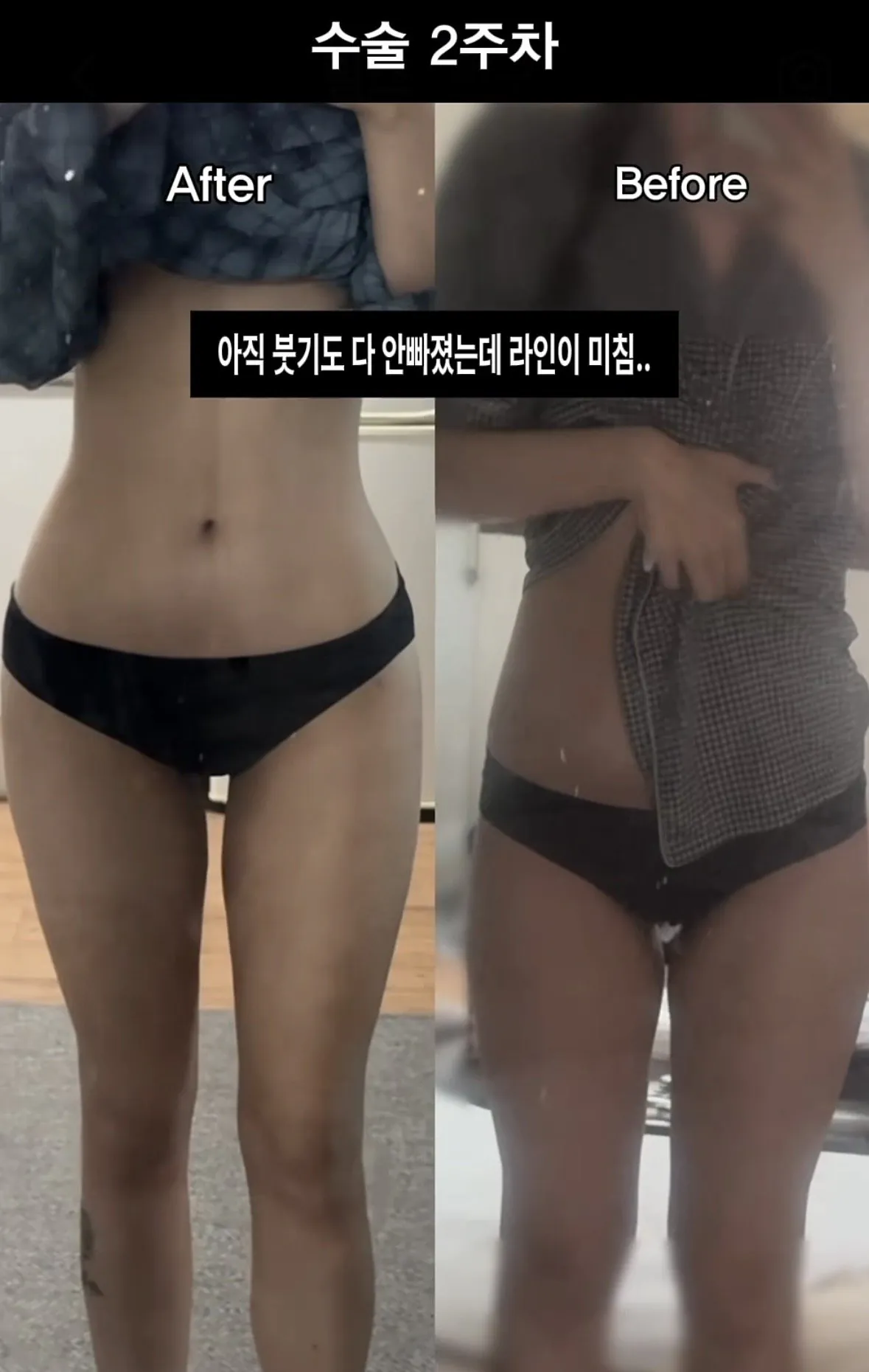 요즘 여자들 사이에 유행중인 신종 몸매 성형수술 허파고리 수술 (13)