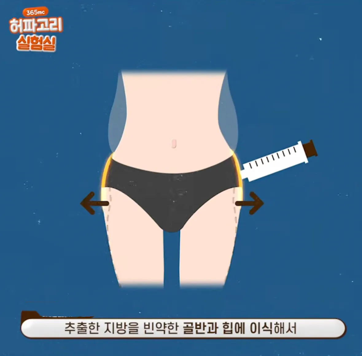요즘 여자들 사이에 유행중인 신종 몸매 성형수술 허파고리 수술 (3)