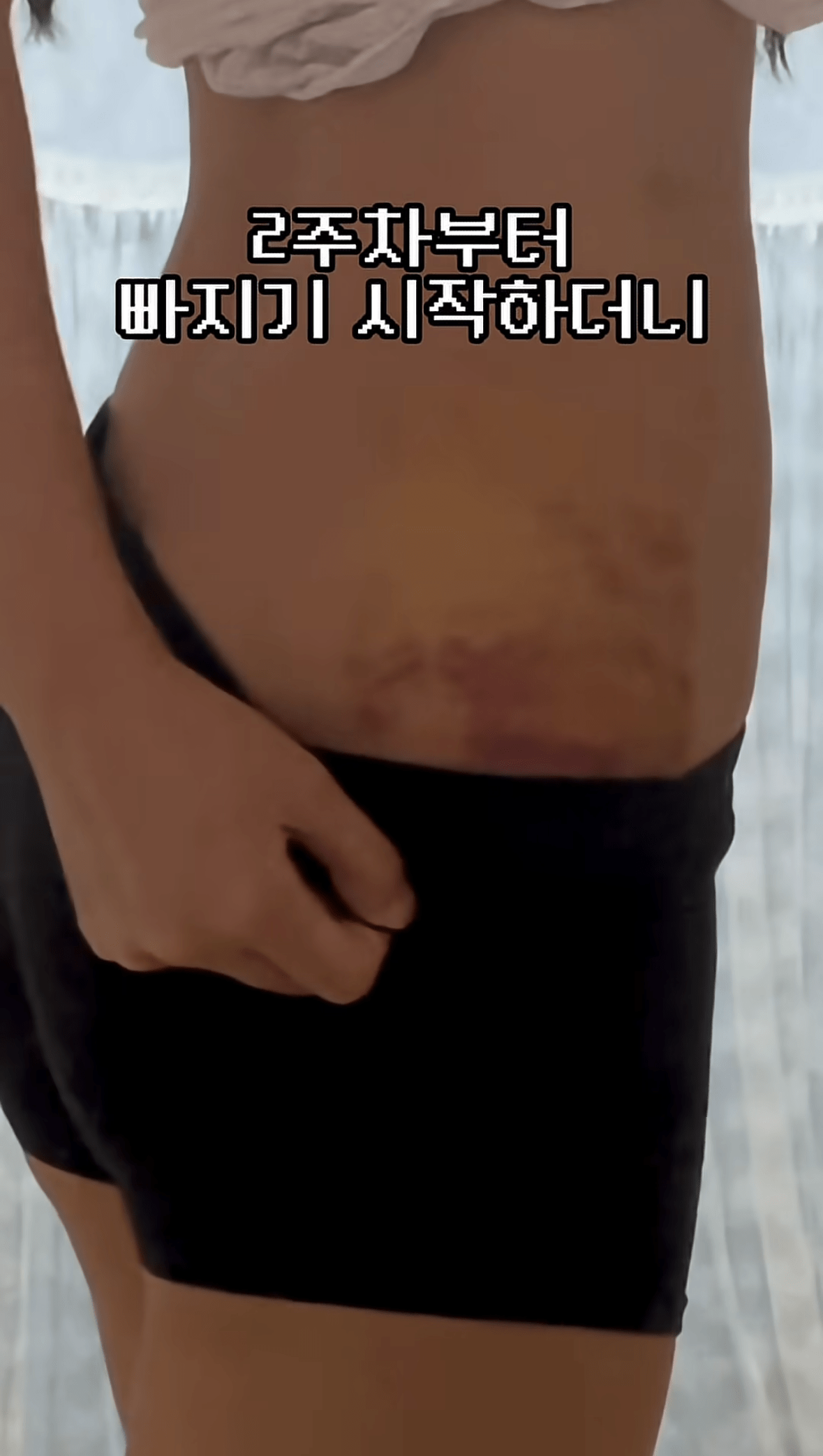 요즘 여자들 사이에 유행중인 신종 몸매 성형수술 허파고리 수술 (23)