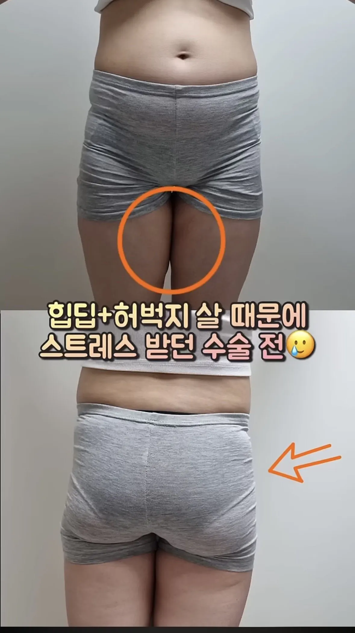 요즘 여자들 사이에 유행중인 신종 몸매 성형수술 허파고리 수술 (22)