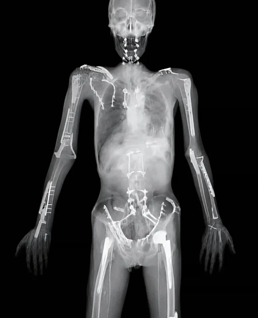 레드불 모터 스포츠 선수의 'X-ray 사진' 공개 (2)