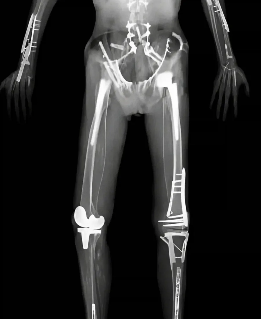 레드불 모터 스포츠 선수의 'X-ray 사진' 공개 (3)