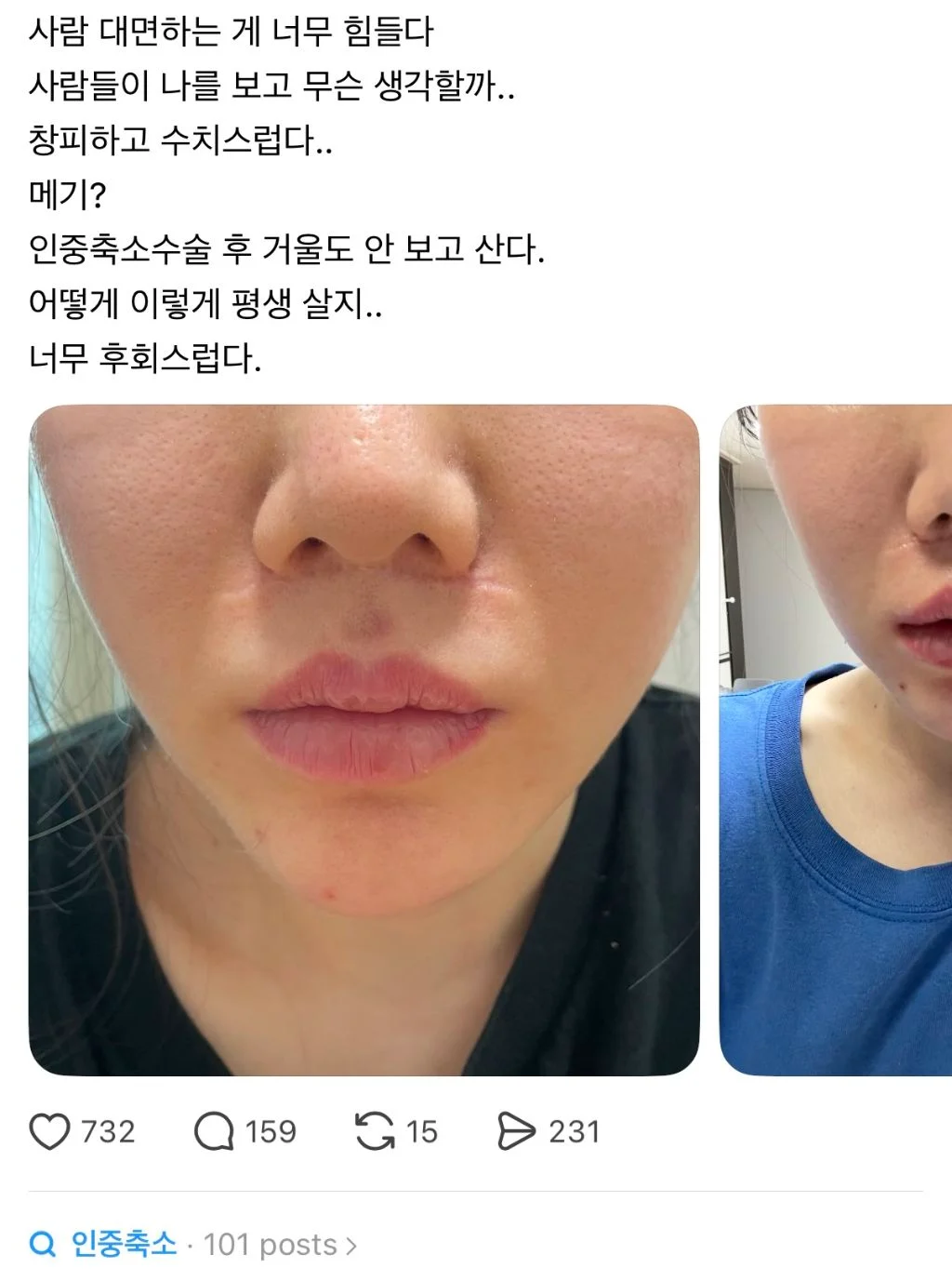 쓰레드에서 핫한 인중축소 성형수술 피해자들 (3)