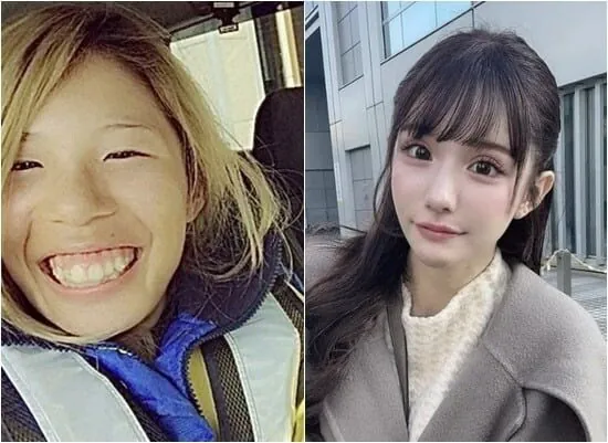 2억원치 성형결과 (2)
