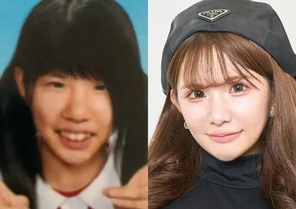 2억원치 성형결과 (4)