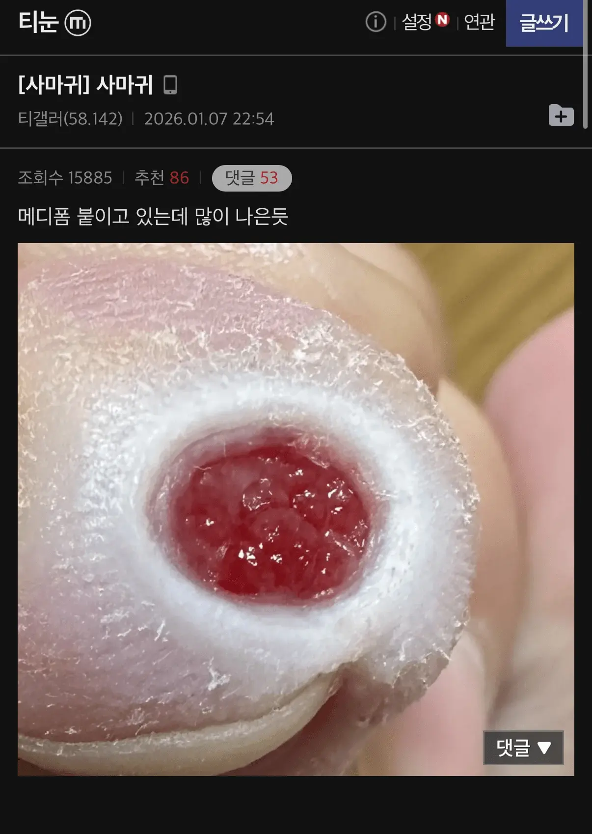 (극혐) 티눈갤에 올라온 메디폼 성능 (2)