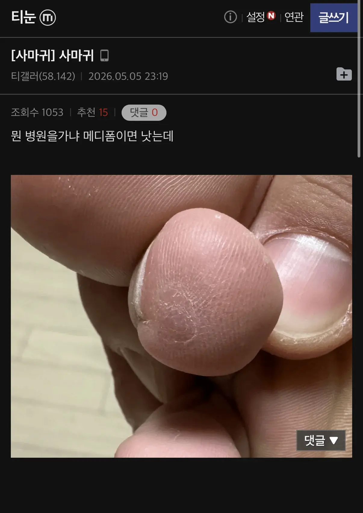 (극혐) 티눈갤에 올라온 메디폼 성능 (3)