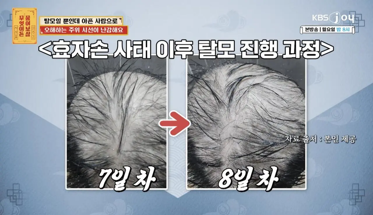 물어보살, 10일만에 탈모가 온 사람 (10)