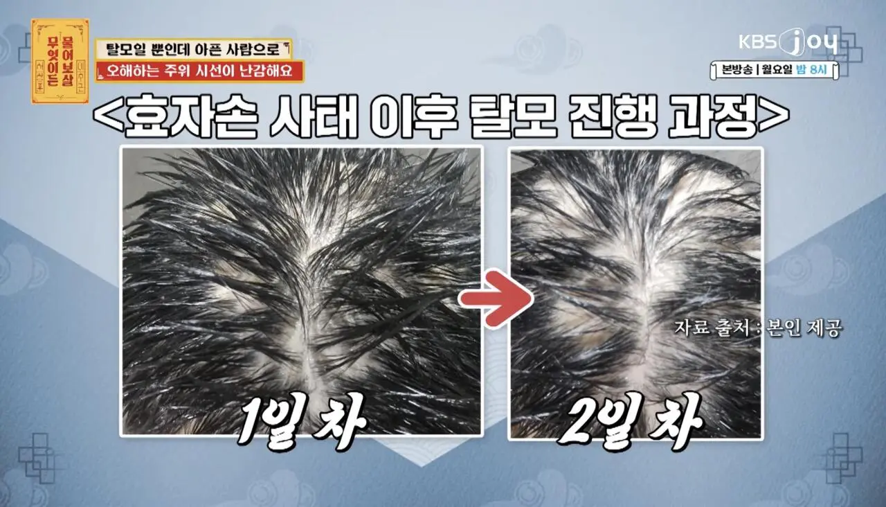 물어보살, 10일만에 탈모가 온 사람 (8)