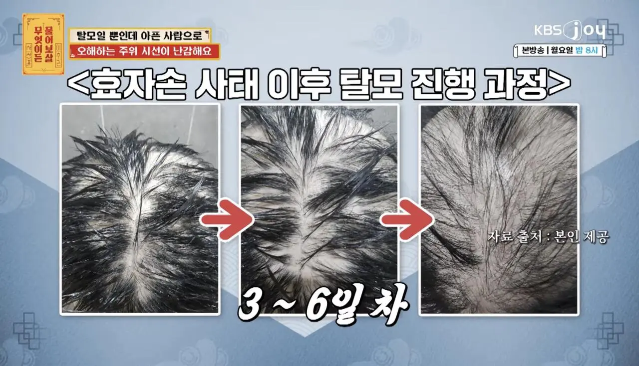 물어보살, 10일만에 탈모가 온 사람 (9)