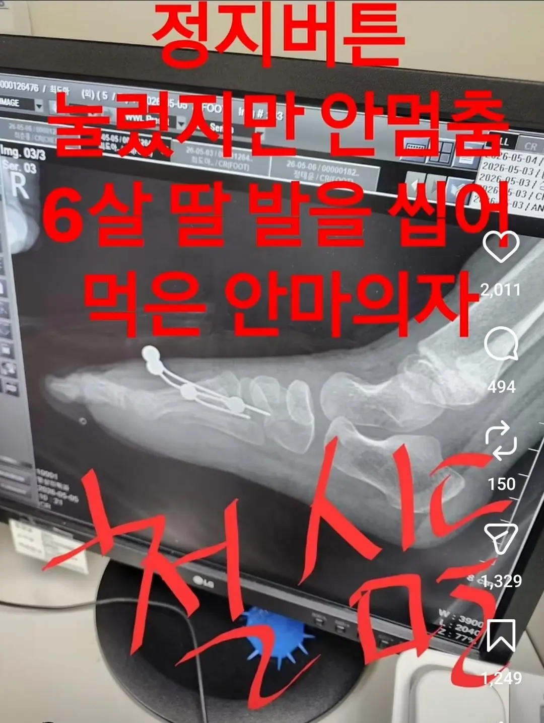 안마의자에 발 뼈가 분쇄된 6살 아이 (10)