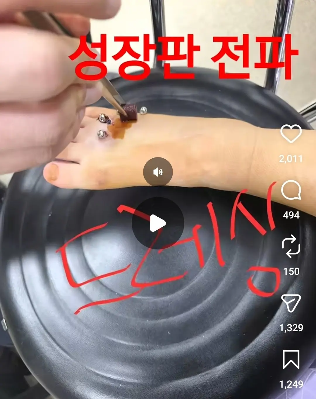 안마의자에 발 뼈가 분쇄된 6살 아이 (3)