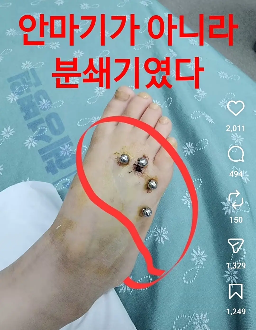 안마의자에 발 뼈가 분쇄된 6살 아이 (6)