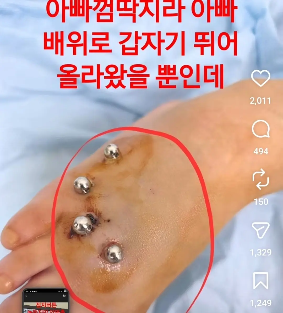 안마의자에 발 뼈가 분쇄된 6살 아이 (9)